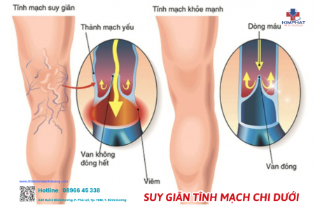 Chẩn đoán và điều trị suy giãn tĩnh mạch chi dưới mãn tính